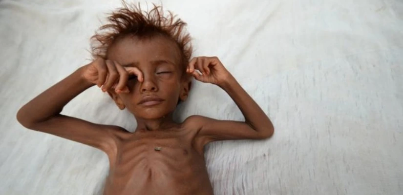 Malnutrition And Its Types